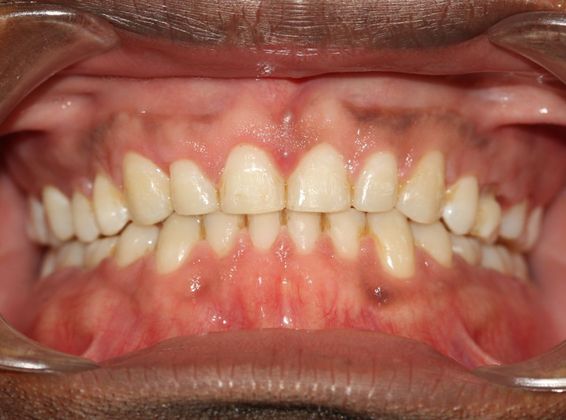 Tooth Spacing Large Space - After