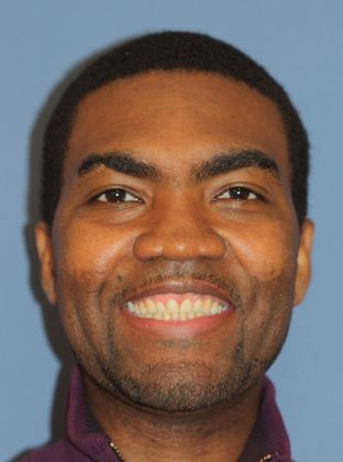 Tooth Spacing: Large Space - After