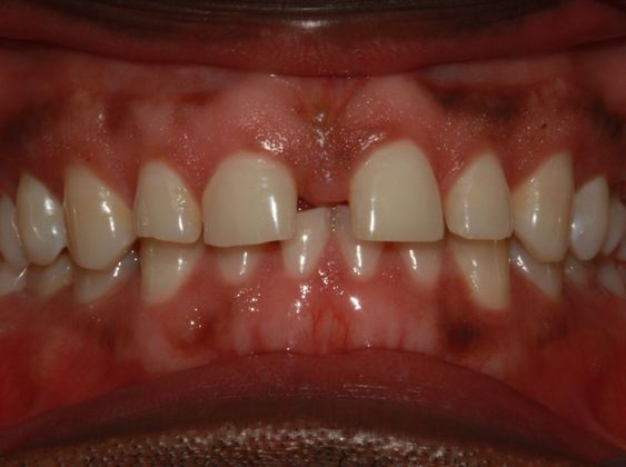 Tooth Spacing Large Space - Before