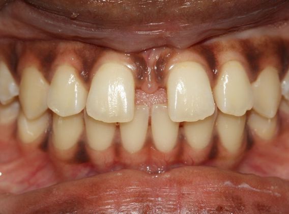 Tooth Spacing: Huge Diastema - Before