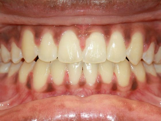 Tooth Spacing: Huge Diastema - After