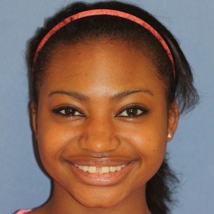 Tooth Spacing Huge Diastema - Before