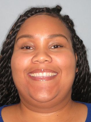 Tooth Spacing Space and Cross Bite - After