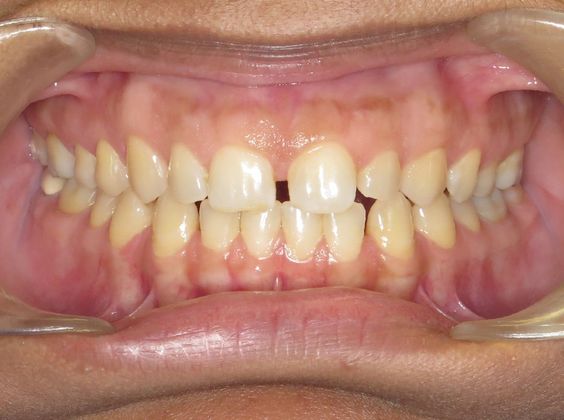 Tooth Spacing: Space and Cross Bite - Before
