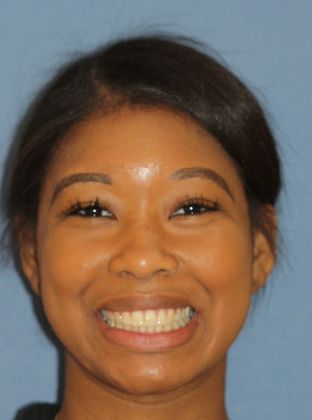 Tooth Spacing Teeth Space - After