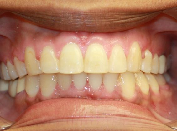 Tooth Spacing: Teeth Space - After