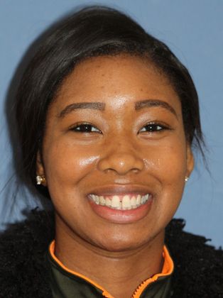 Tooth Spacing Teeth Space - Before