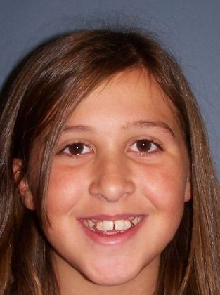 Open Bite Crowding and Open Bite - Before