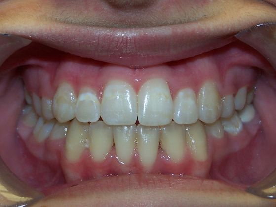 Open Bite: Crowding and Open Bite - After