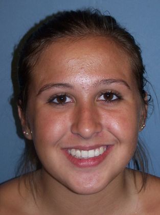 Open Bite Crowding and Open Bite - After