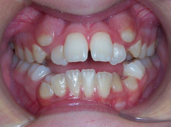 Open Bite: Crowding and Open Bite - Before