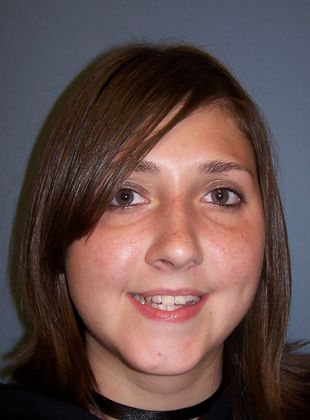 Open Bite Tongue Habit Open Bite  - Before