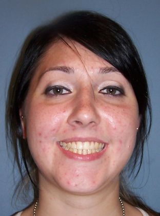 Open Bite Tongue Habit Open Bite  - After