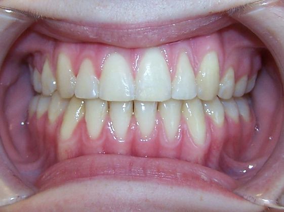 Open Bite: Tongue Habit Open Bite - After