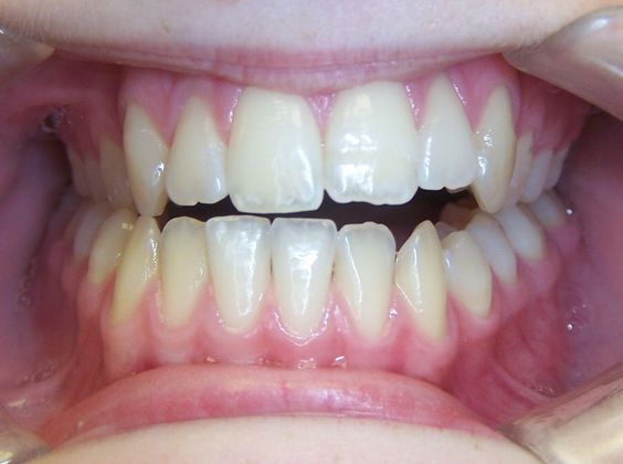 Open Bite: Tongue Habit Open Bite - Before