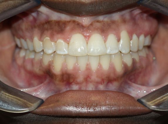 Open Bite Tongue Habit  - After