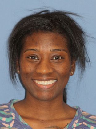 Open Bite: Tongue Habit - After