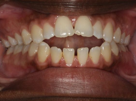 Open Bite Tongue Habit  - Before