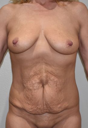 Massive Weight Loss : Case 67 - Before