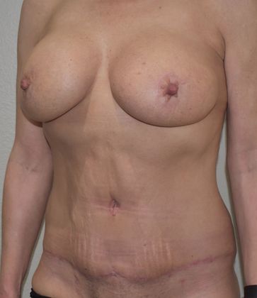 Massive Weight Loss : Case 67 - After