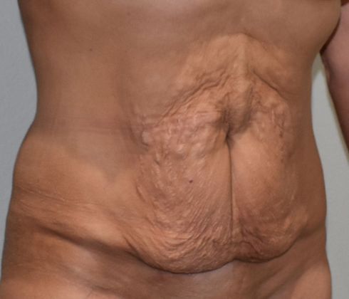 Tummy Tuck (Abdominoplasty): Case 223 - Before
