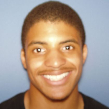 Over Bite/Over Jet Over bite and Space - Before