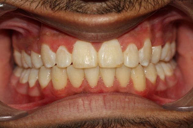 Over Bite/Over Jet: Over bite and Space - After