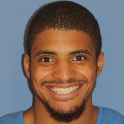 Over Bite/Over Jet Over bite and Space - After