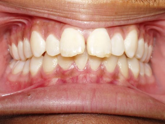 Over Bite/Over Jet: Over bite and Space - Before