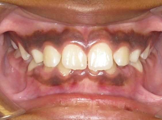 Deep Bite - Overlapping Teeth: Deep Bite/spaces - Before