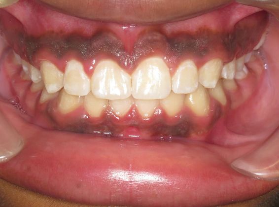 Deep Bite - Overlapping Teeth: Deep Bite/spaces - After