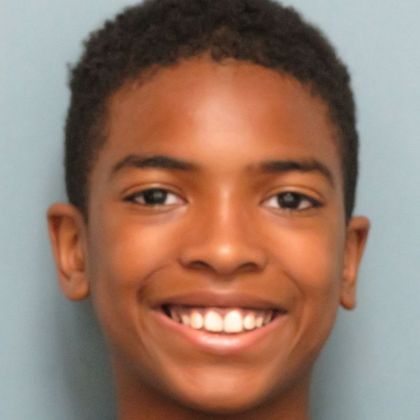 Deep Bite - Overlapping Teeth Deep Bite/spaces - Before