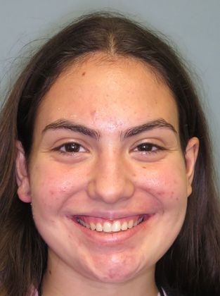 Deep Bite - Overlapping Teeth: Deep Bite/Narrow Arch - Before