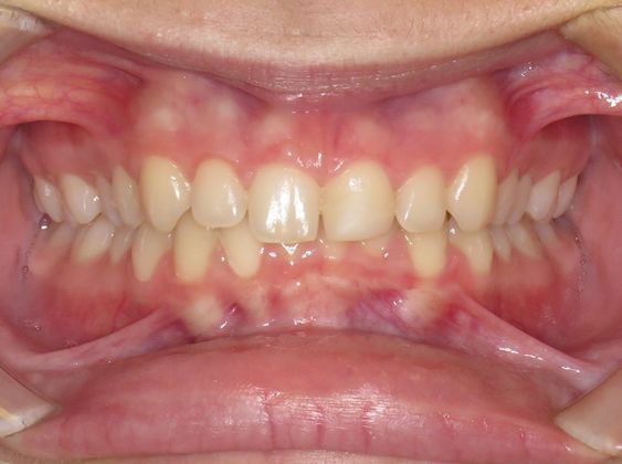 Deep Bite - Overlapping Teeth Deep Bite/Narrow Arch - Before