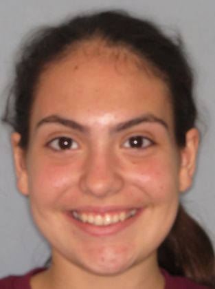 Deep Bite - Overlapping Teeth: Deep Bite/Narrow Arch - After