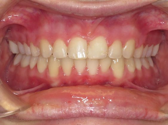 Deep Bite - Overlapping Teeth Deep Bite/Narrow Arch - After