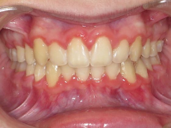 Deep Bite - Overlapping Teeth: Deep Bite and Narrow Arches - After