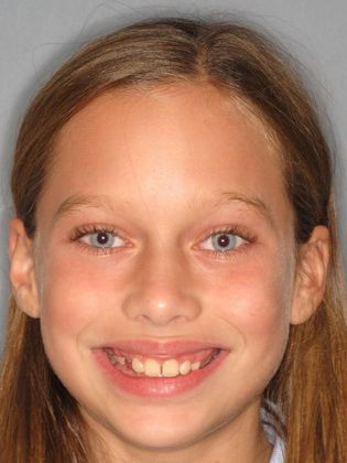 Deep Bite - Overlapping Teeth Deep Bite and Narrow Arches - Before