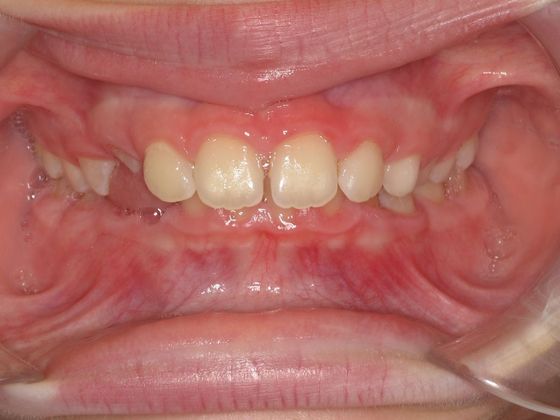 Deep Bite - Overlapping Teeth: Deep Bite and Narrow Arches - Before