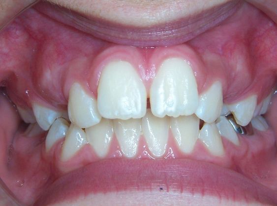 Narrow Arch - Narrow Smile: Narrow Arch/Locked Canines - After