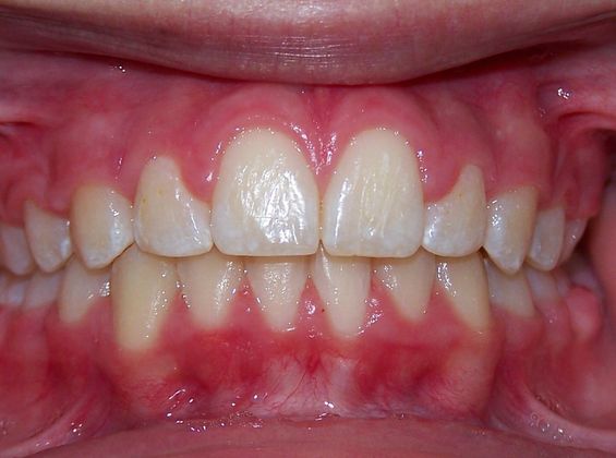 Narrow Arch - Narrow Smile: Narrow Arch/Locked Canines - After