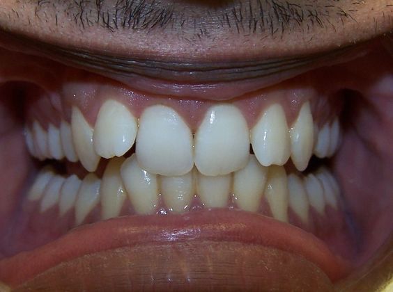 Open Bite: Open Posterior Bite - Before