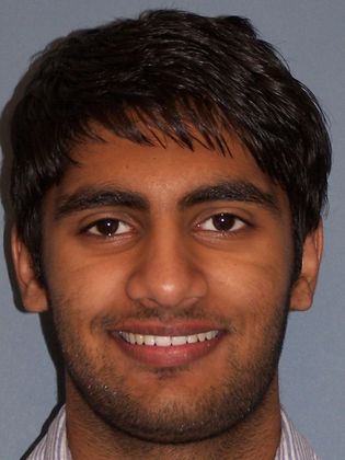 Open Bite Open Posterior Bite - After