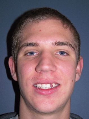 Missing Teeth : Missing Left Lateral - After