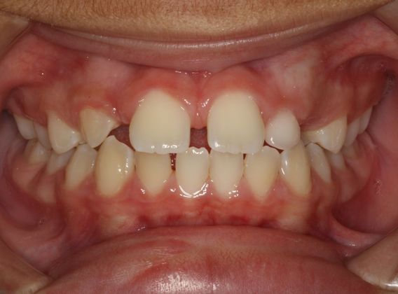 Missing Teeth  False Teeth - Before