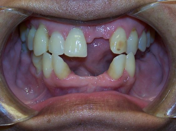 Missing Teeth  False Teeth Both Arches - Before