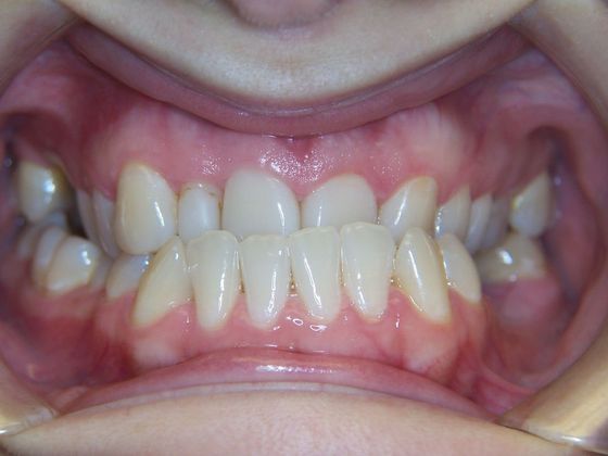 Missing Teeth  Under Bite and Missing a Tooth - Before