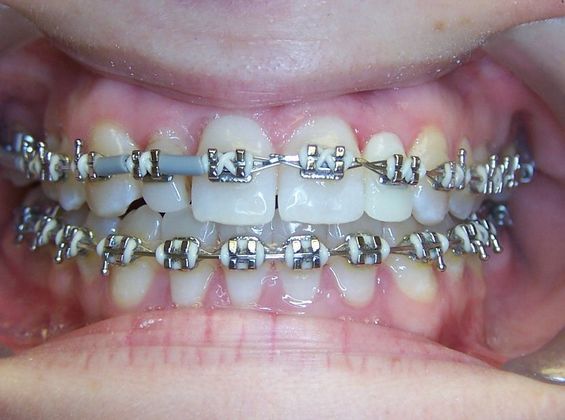 Missing Teeth  Under Bite and Missing a Tooth - After