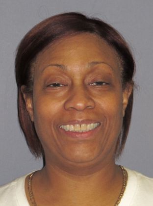 Senior: Over Bite - After