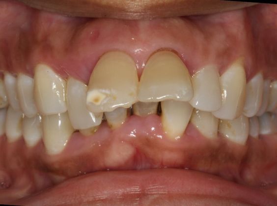 Senior Over Bite - Before